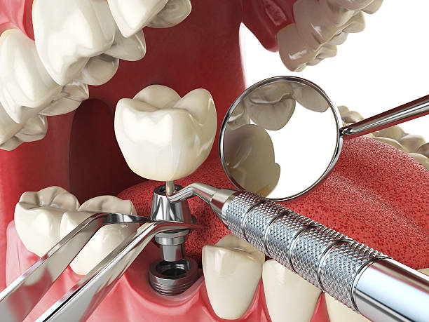 Best Urgent Care for Lost Fillings or Crowns in Strodes Mills, PA